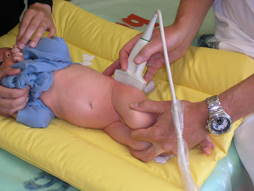 Sonografické vyšetření kyčelních kloubů novorozence