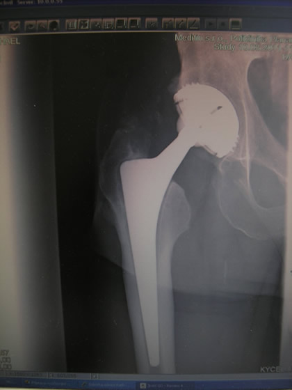 Totální endoprotéza kyčle - rentgenový snímek