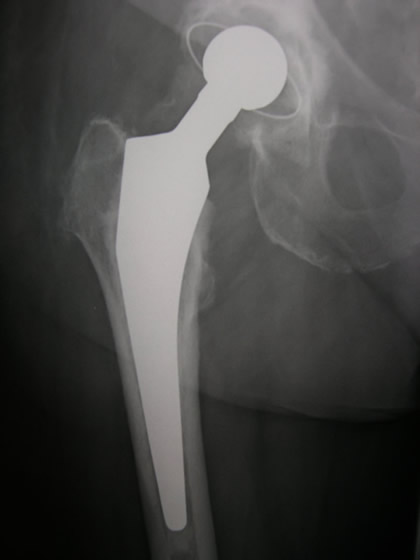 Totální endoprotéza kyčle - rentgenový snímek