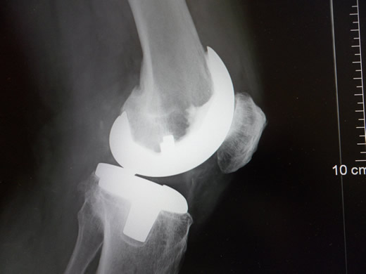 Totální endoprotéza kolenního kloubu - rentgenový snímek